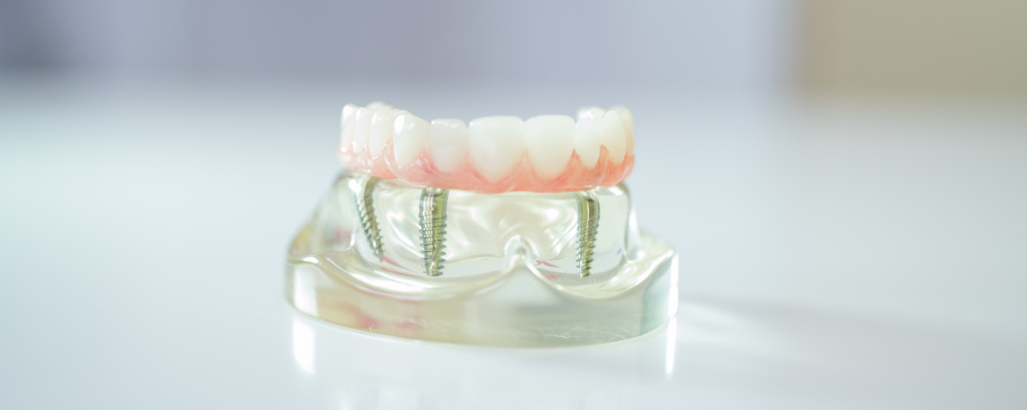 What is a dental implant? 