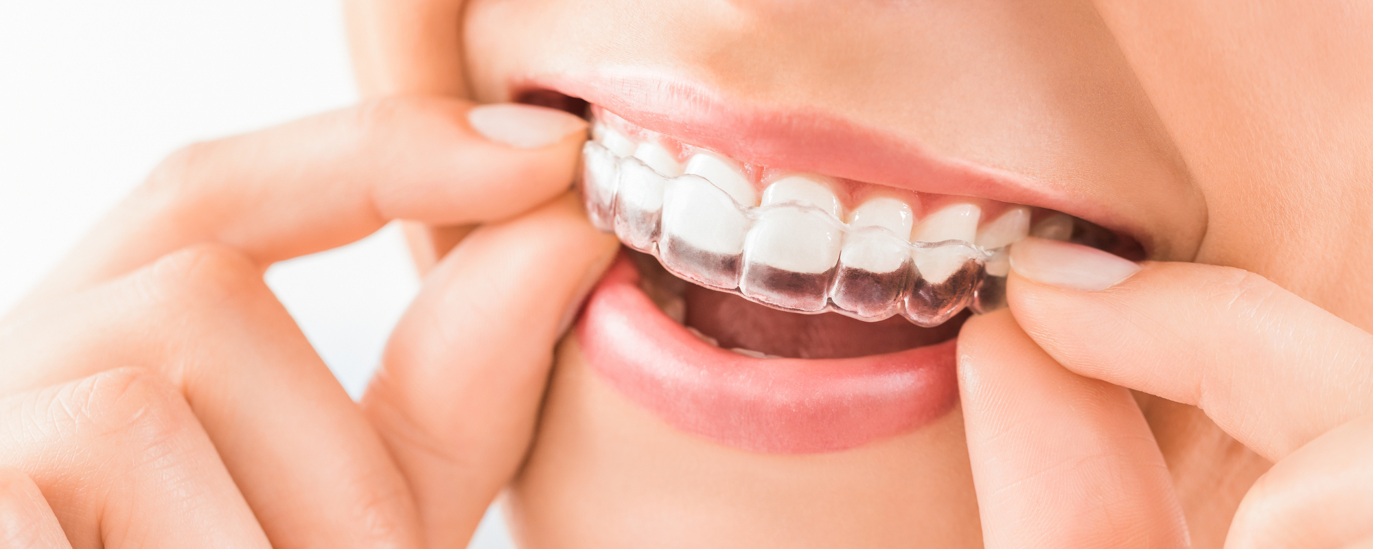 Clear Aligner Treatment Orthodontics Park Dental Specialists